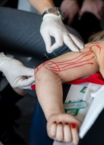 cursuri dry needling si acupunctura, medboost academy, cristian drosu